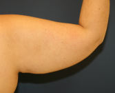 Feel Beautiful - Arm Reduction 33 - Before Photo